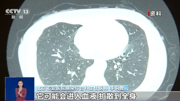 女孩脑部被真菌侵蚀出现“空洞”？大扫除要警惕霉变粉尘！(图4)