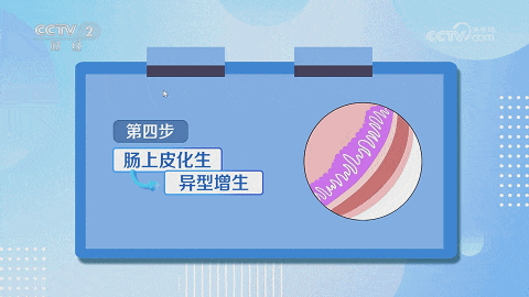 感染“幽门螺杆菌”到“胃癌”，只有5步！(图4)